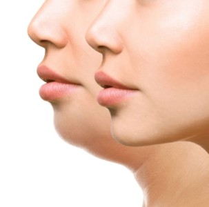 Chin Contouring